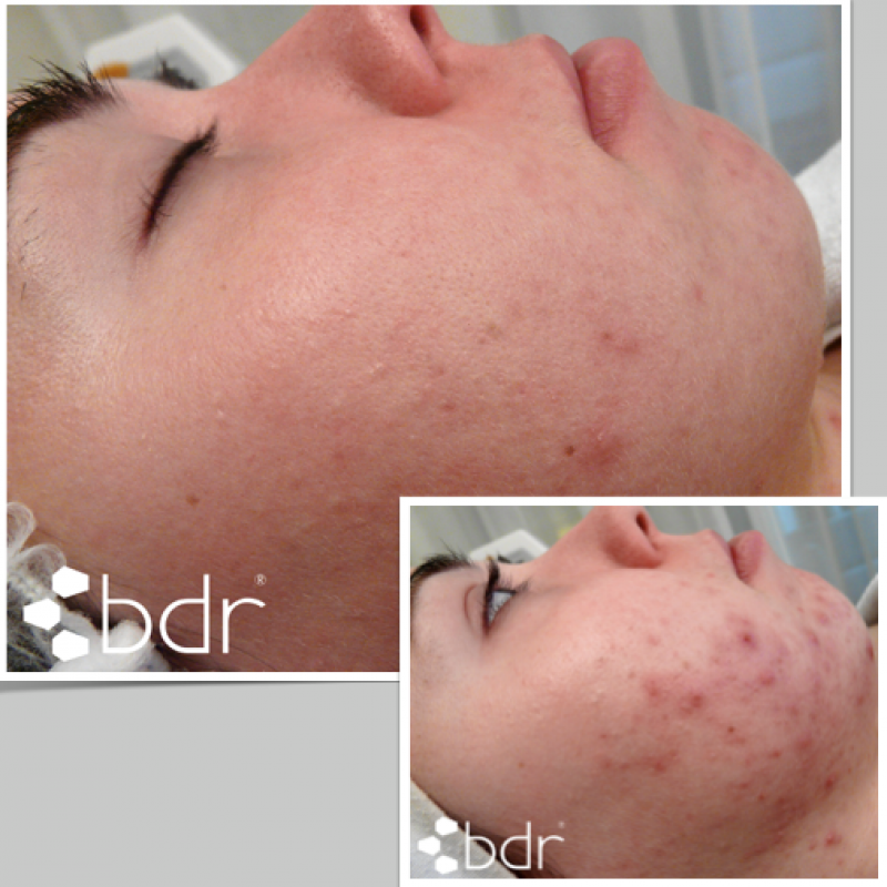 bdr® Single Line - Aparat cosmetica medicala pentru tratamente combinate de regenerare a pielii si rezolvarea diverselor probleme specifice