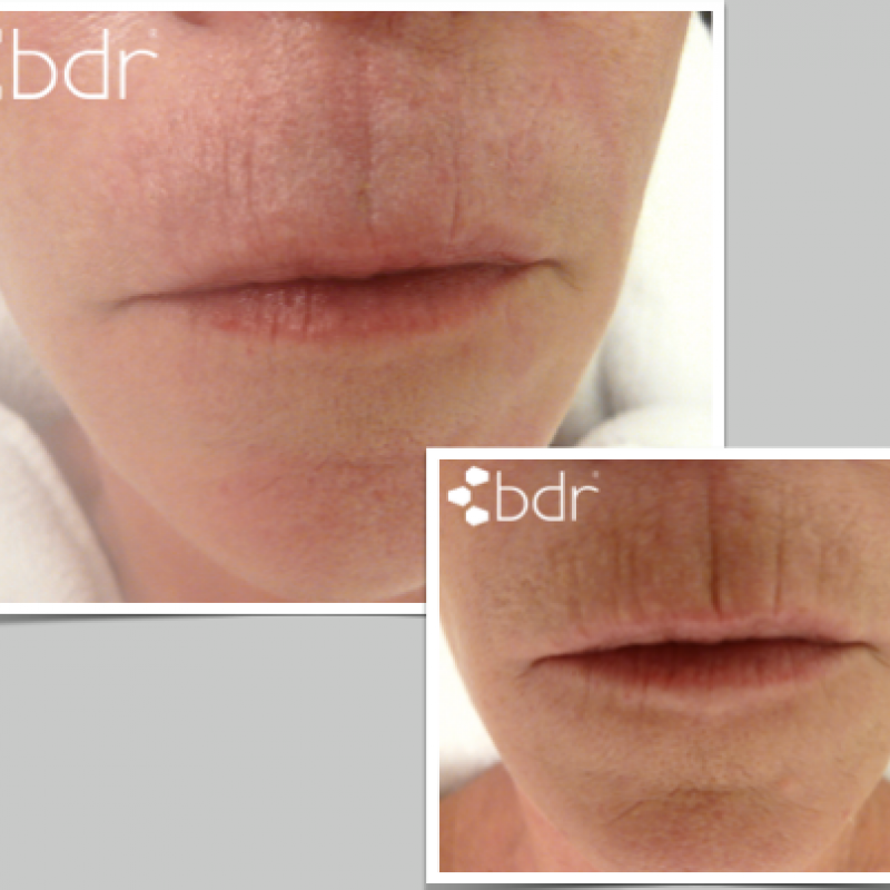 bdr® Single Line - Aparat cosmetica medicala pentru tratamente combinate de regenerare a pielii si rezolvarea diverselor probleme specifice